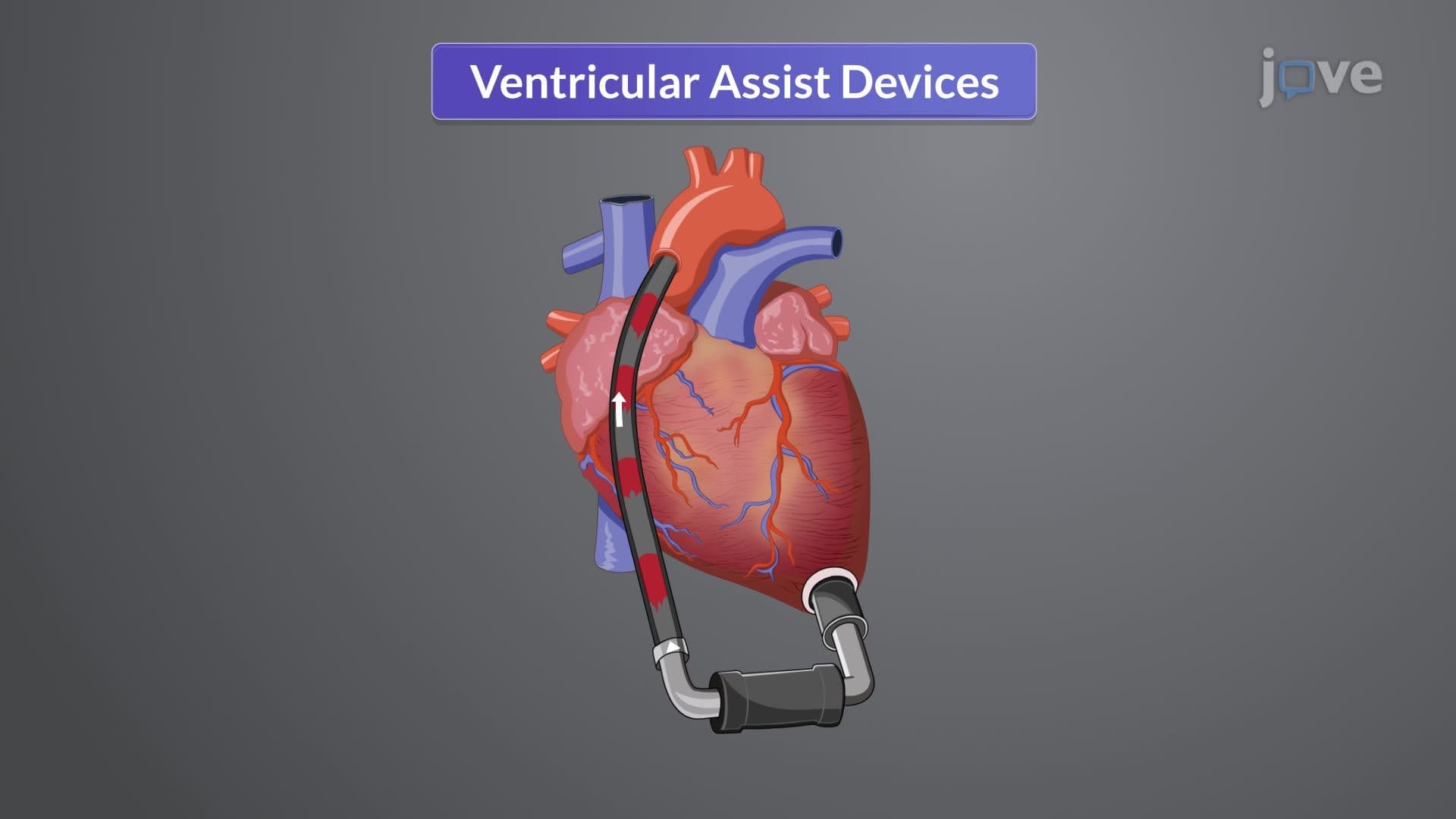 Heart Failure VI: Adjunct Therapies